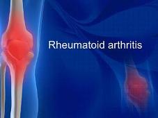 Rheumatoid Arthritis